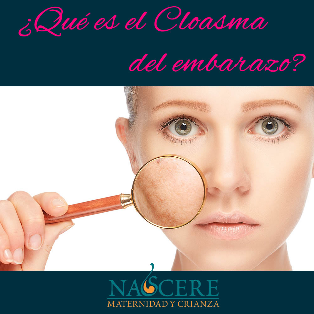 ¿Qué es el cloasma del embarazo?